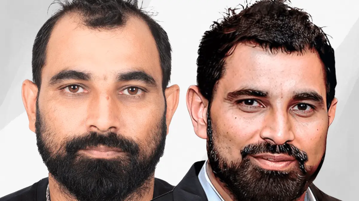 Mohammad Shami hair transplant before and after results at Eugenix Hair Sciences